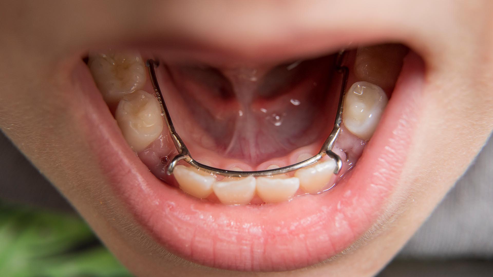 Space Maintainers. The view of a space maintainer that is placed into a child's mouth.