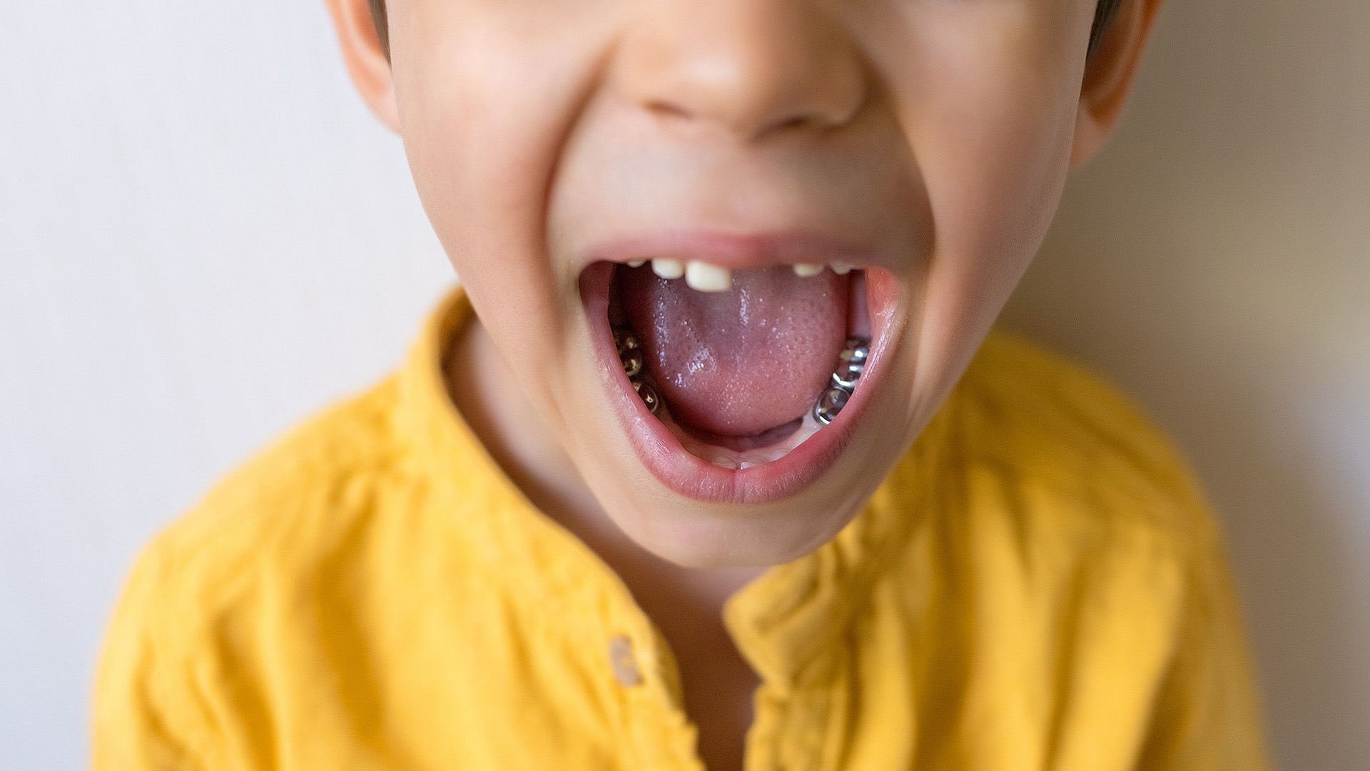 Tooth cap vs crown, what are caps for teeth