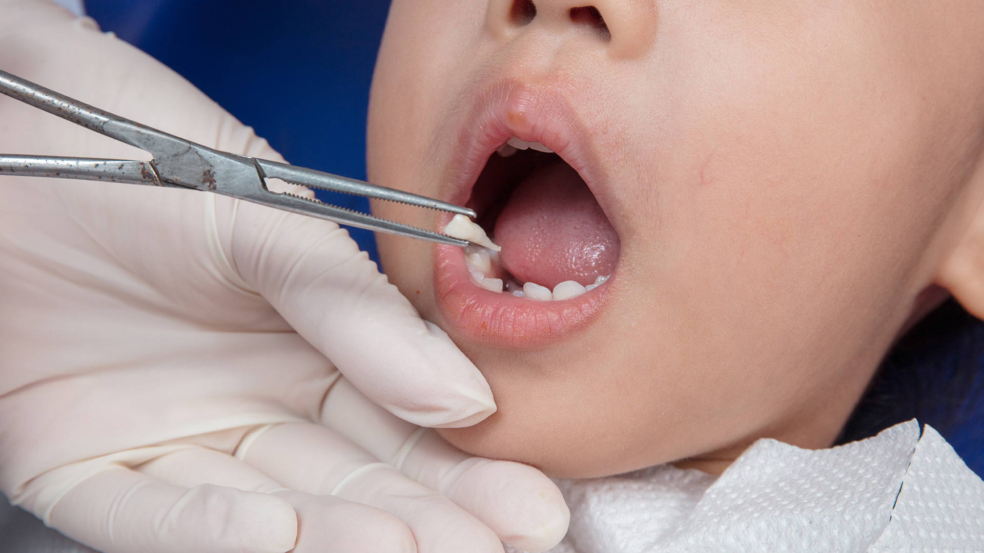 Common Reasons for Kids to Need Tooth Extractions
